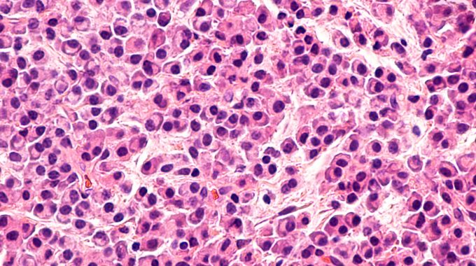 Descoberta Mutação Genética Que Desencadeia Leucemia Aguda Grave