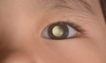 Imagem De Criança Com Retina Do Olho Branco