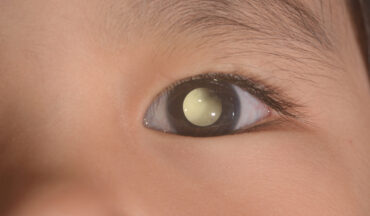 Imagem De Criança Com Retina Do Olho Branco