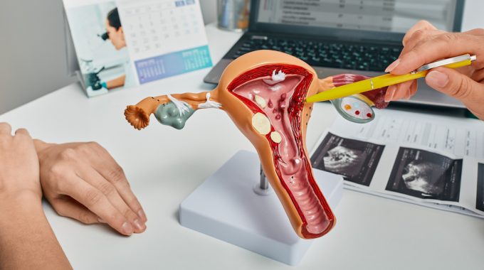 Ginecologista Mostrando Pólipos De Endométrio Do útero Usando Modelo Anatômico Durante Consulta A Paciente Do Sexo Feminino.