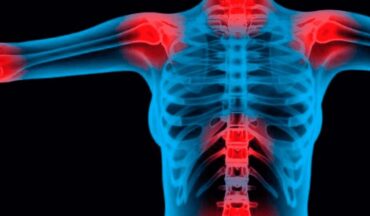 CGI de raio x, com pontos vermelhos associados à dor em várias partes do corpo analisado.